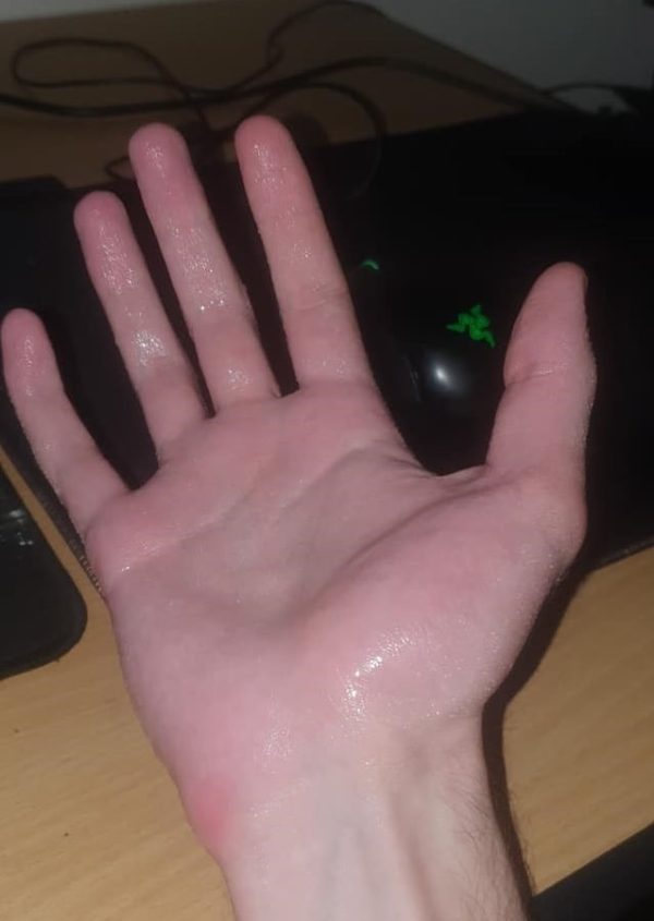 How To Stop Getting Sweaty Hands While Gaming 269 Free Shipping Sweaty Hand 600x845 